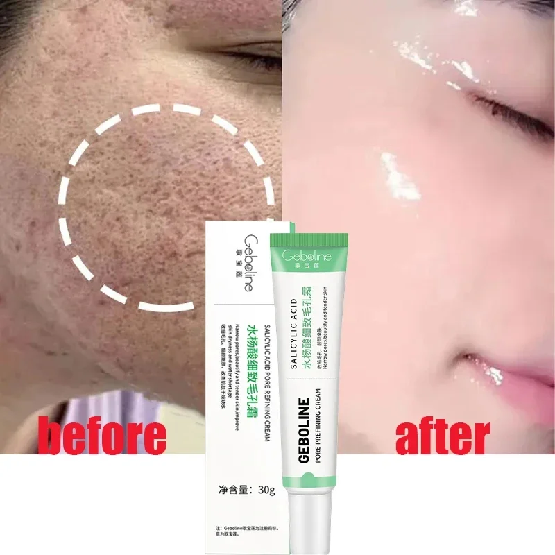 Skincare Salicylic Acid - 살리실산 모공 수축 크림, 빠른 제거,