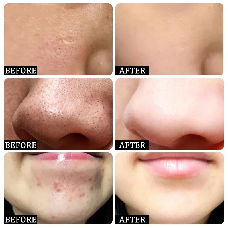 살리실산 모공 클리어링 크림 모공 축소 블랙헤드 제거  - Azelaic Acid Cream 리뷰 및 가격