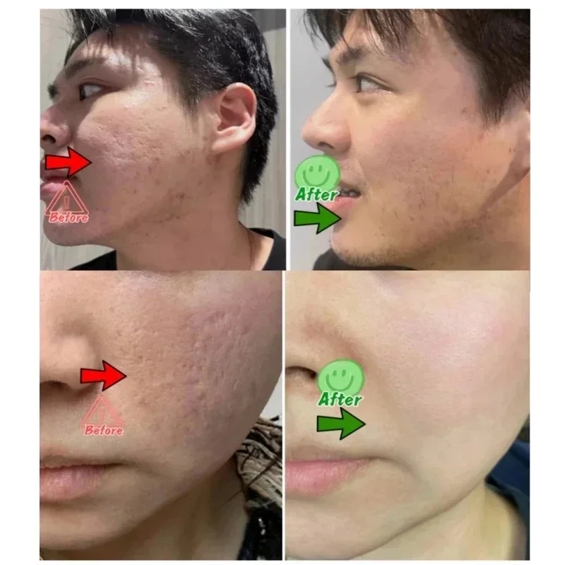 살리실산 모공 클리어링 크림 모공 축소 블랙헤드 제거  - Azelaic Acid Cream 리뷰 및 가격
