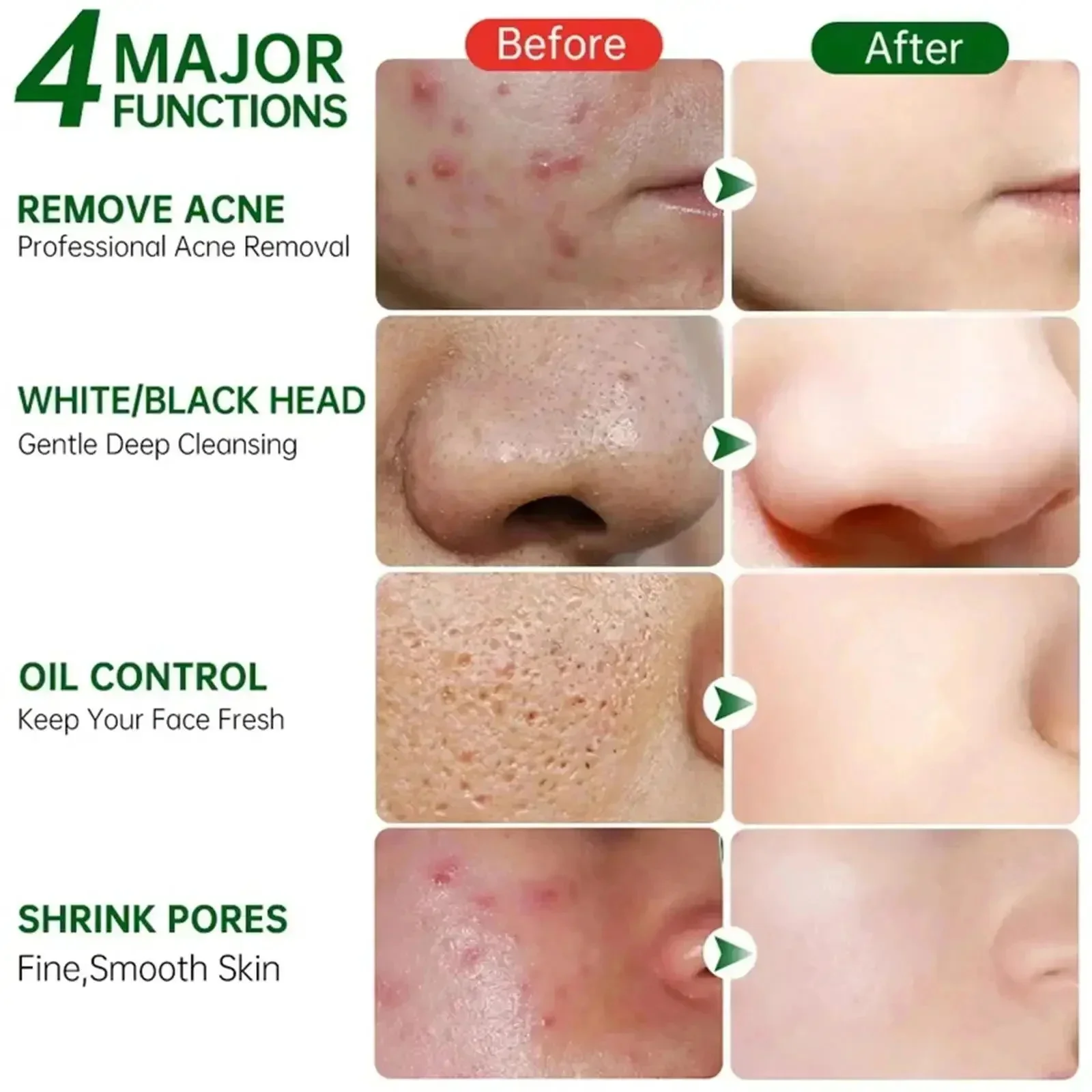살리실산 모공 클리어링 크림 모공 축소 블랙헤드 제거  - Azelaic Acid Cream 리뷰 및 가격