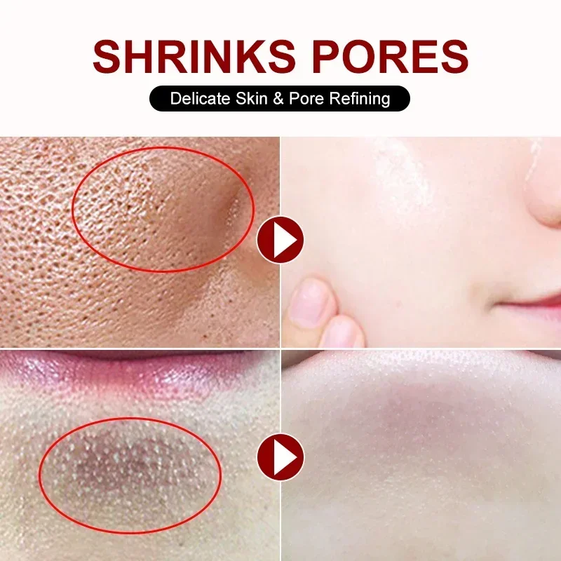 살리실산 모공 수축 크림, 빠른 제거, 큰 모공 제거, - Skincare Salicylic Acid 리뷰 및 가격