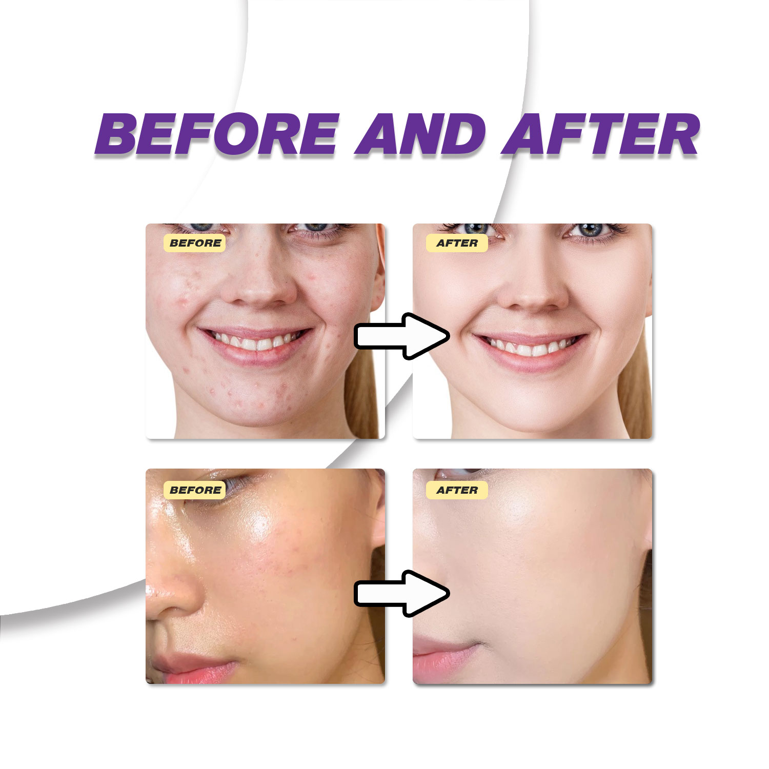순한 아젤라산 크림은 칙칙한 피부를 개선하고 거친 피부 - Azelaic Acid Cream 리뷰 및 가격