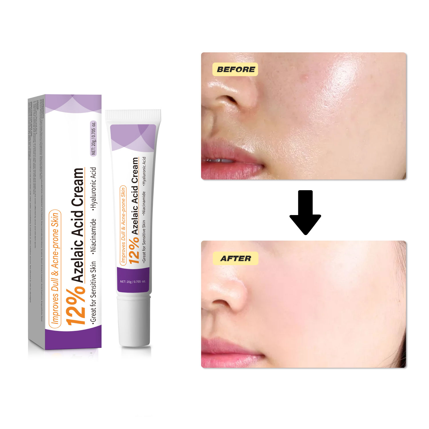 순한 아젤라산 크림은 칙칙한 피부를 개선하고 거친 피부 - Azelaic Acid Cream 리뷰 및 가격