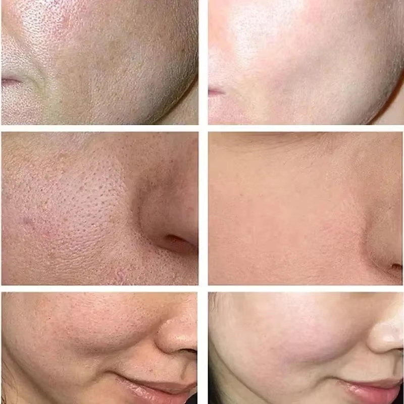 살리실산 모공 축소 크림 빠른 모공 축소 블랙헤드 제거 - Skincare Salicylic Acid 리뷰 및 가격